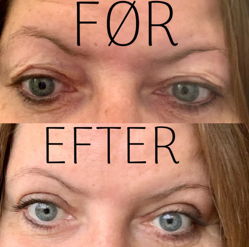 Linda, før og efter øjenlågsoperation